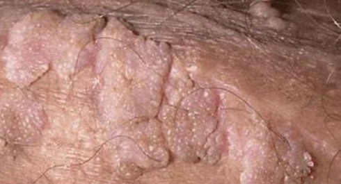 Bé trai 6 tuổi bị sùi mào gà, bố mẹ ngơ ngác nhìn nhau - ảnh 1