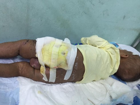 Con suýt chết vì mẹ đắp dọc mùng tự chữa bệnh - ảnh 1