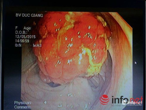 Ung thư đại trực tràng xếp thứ 4 ở Việt Nam - ảnh 1