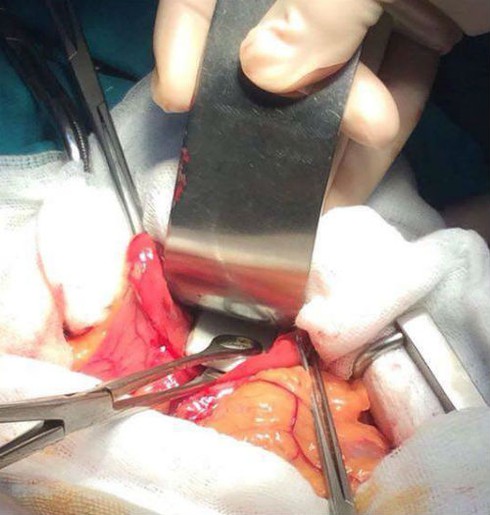 Gắp 59 mảnh chén vỡ từ bụng bệnh nhân - ảnh 1