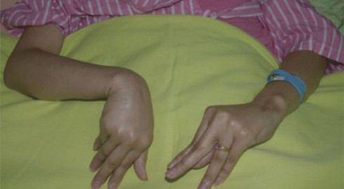 Cảnh báo bệnh co rút chân tay do bữa ăn nhiều đạm thiếu canxi - ảnh 1