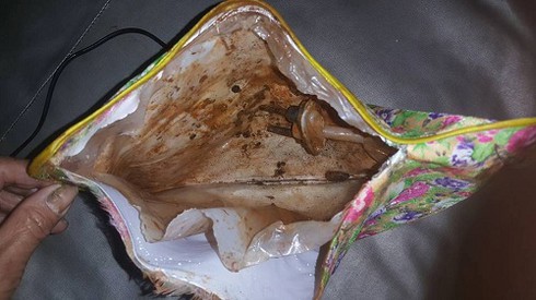 Bỏng do túi sưởi phát nổ - ảnh 1