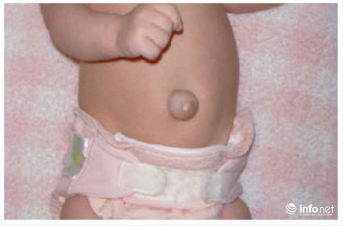 Rốn con tự nhiên lồi lên là bệnh gì? - ảnh 1