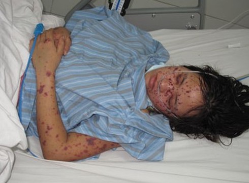 Cảnh báo bệnh viêm não mô cầu nguy hiểm xuất hiện tại Hải Dương - ảnh 1