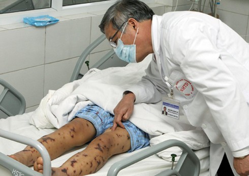 Thêm 1 người viêm não mô cầu, vắc xin đang hết - ảnh 1