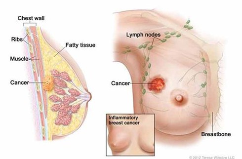 Căn bệnh cực kỳ nguy hiểm, mỗi phút giết một người - ảnh 1