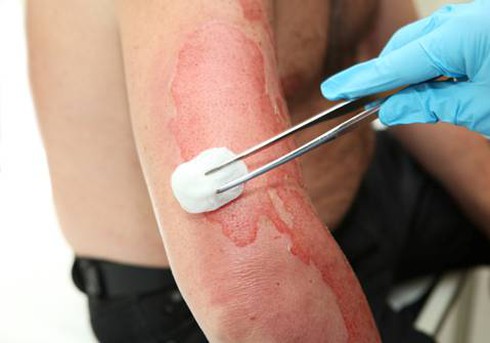 Mâu thuẫn, người đàn ông tạt axit khiến 6 người bị bỏng - ảnh 1