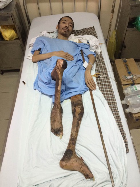 Bệnh nhân suy thận, bị liệt 25 năm cần được giúp đỡ khẩn cấp - ảnh 1