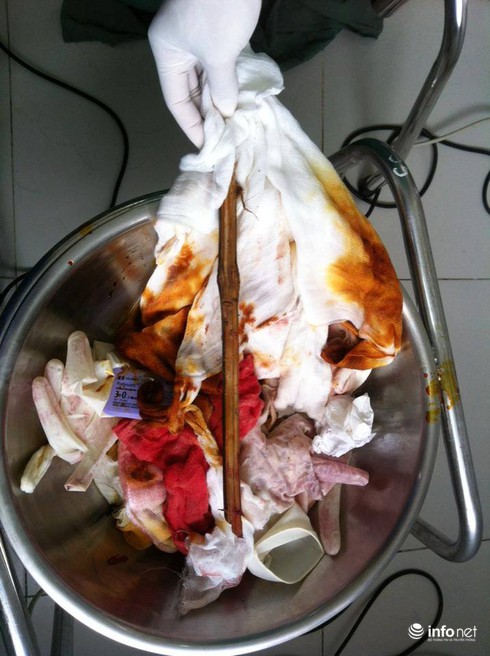 Cứu sống bệnh nhân bị cọc đâm vào mắt phải vào tận não - ảnh 1