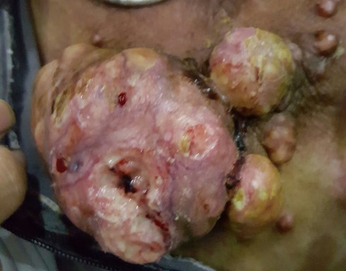 Sát thủ 1000 đồng và căn bệnh ung thư kinh hoàng - ảnh 1