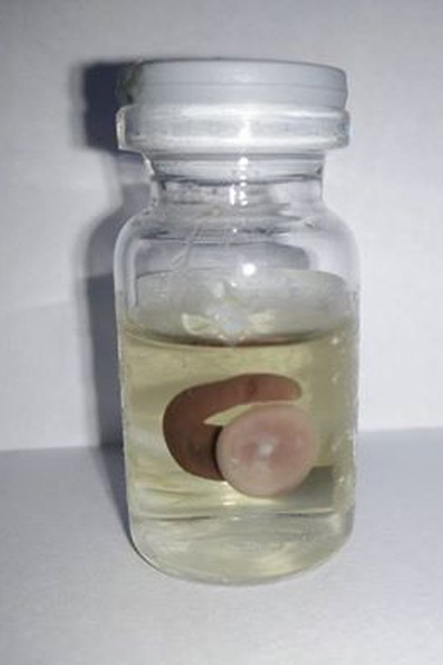 Gắp con vắt dài 3cm từ mũi người bệnh - ảnh 1