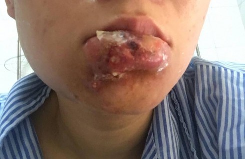 Tiêm filler thẩm mỹ để căng mọng nguy cơ mất mạng, mù mắt - ảnh 1