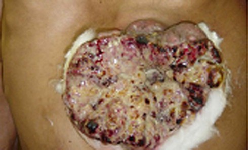 Căn bệnh ung thư phổ biến nhưng khó phát hiện nhất hiện nay - ảnh 1