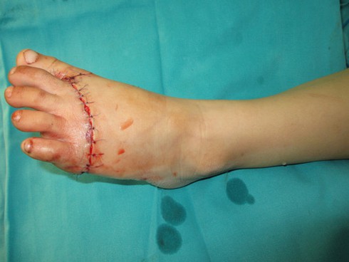 Những vụ đứt lìa chân hi hữu được các bác sĩ nối thành công - ảnh 1