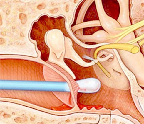 Ngoáy tai bằng tăm bông: Sướng một, hại mười - ảnh 1