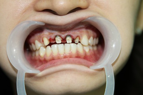 Đừng coi thường những đau nhức răng thoáng qua - ảnh 1