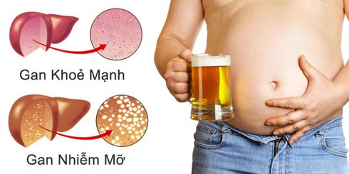 Cảnh báo căn bệnh dẫn đến bụng như cái trống - ảnh 1
