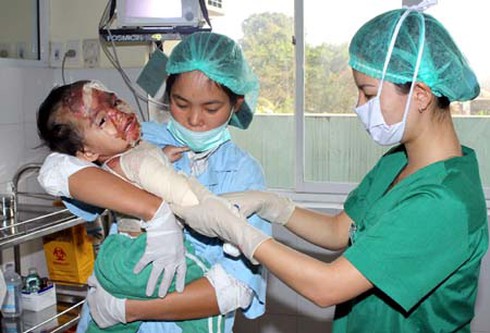 Mùa đông, cảnh báo bỏng nước sôi ở trẻ từ 2 - 5 tuổi - ảnh 1