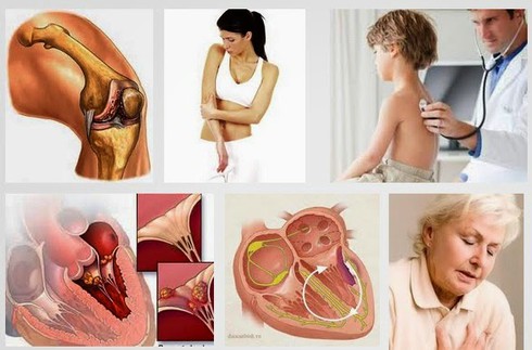 Chuyên gia tim mạch nói về bệnh