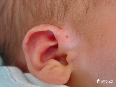 Sưng nửa mặt chỉ vì lỗ hở bằng đầu tăm ở tai - ảnh 1