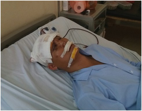 BV đa khoa Mộc Châu cứu sống bệnh nhân chấn thương sọ não, vỡ nền sọ trước - ảnh 1