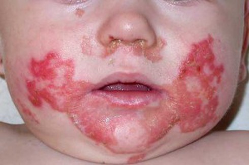 Trẻ lở loét, nôn trớ, rối loạn tiêu hoá cần nghĩ ngay đến thiếu kẽm - ảnh 1