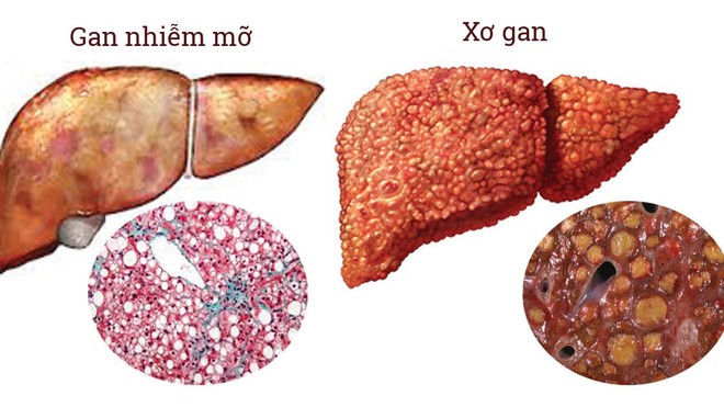 Thói quen xấu nhiều người đang bức tử lá gan của mình