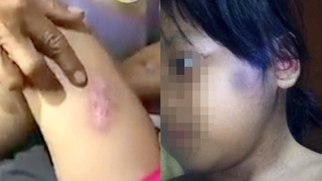 TP.HCM: Phẫn nộ, bé gái 6 tuổi bị cha dượng nghiện ma túy châm tàn thuốc lá vào người