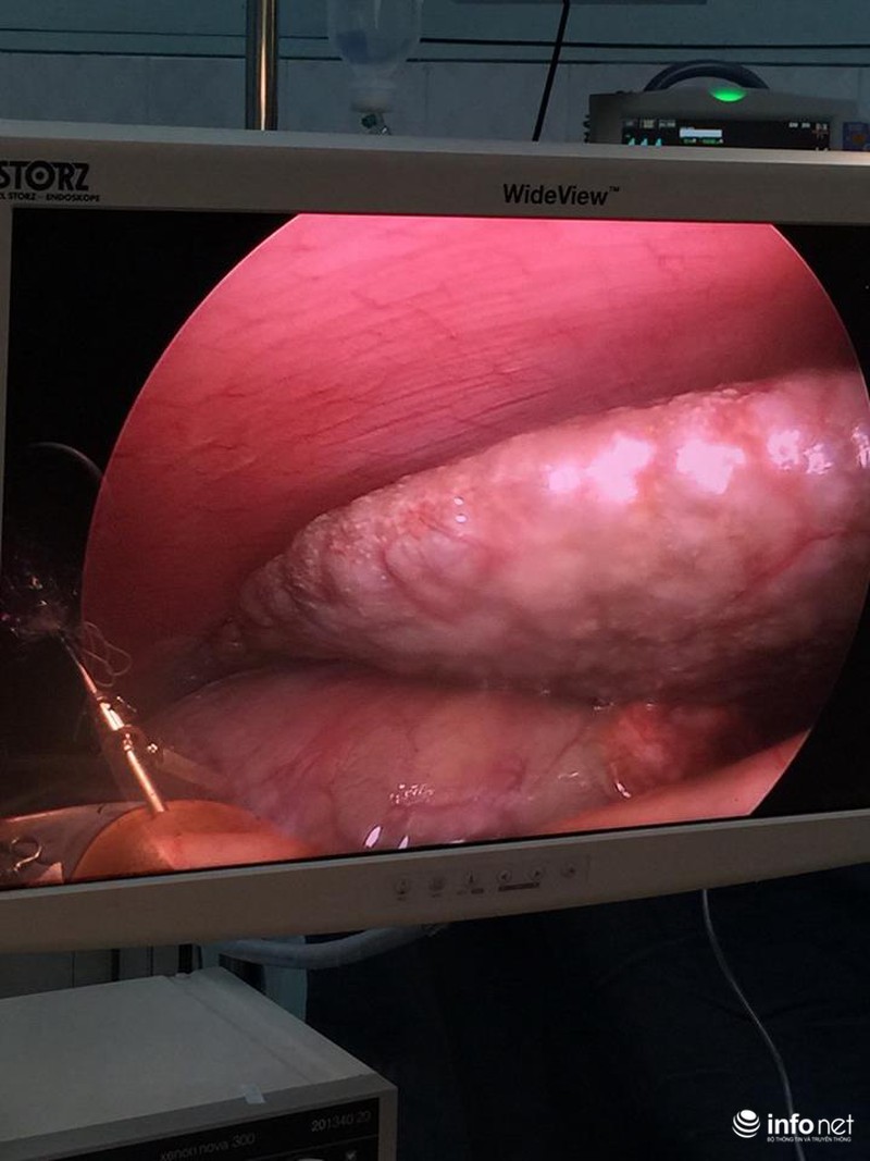 Hành trình chữa bệnh của bé gái người Lào tại Việt Nam - ảnh 2