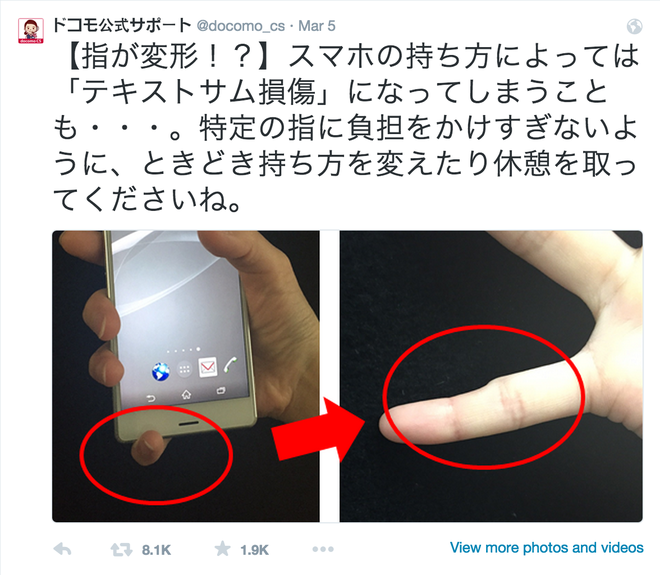 Ngón tay út bị biến dạng nếu dùng smartphone quá nhiều?