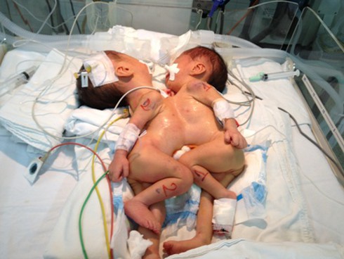 Cặp song sinh dính tim và gan - ảnh 1