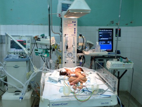 Cặp song sinh dính tim và gan - ảnh 2