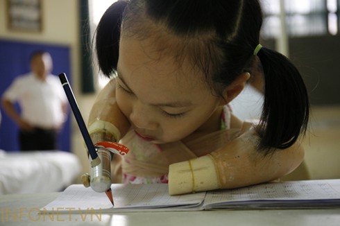 Cuộc sống nghị lực của cháu bé không tay chân - ảnh 5