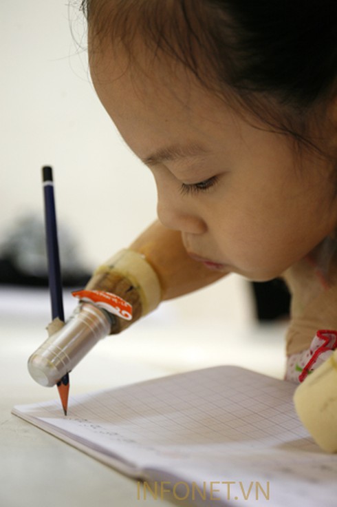 Cuộc sống nghị lực của cháu bé không tay chân - ảnh 6