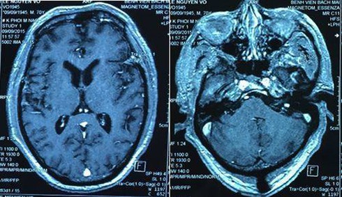 Bệnh nhân Thái Lan sang Việt Nam chữa u não thành công - ảnh 1