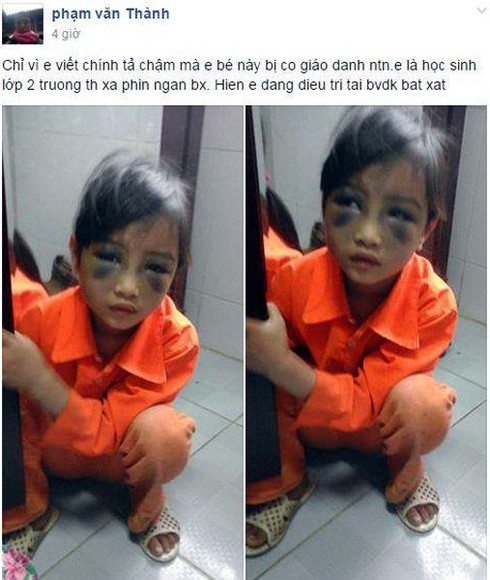Cô giáo đánh học sinh tím bầm mặt bị đề nghị kỷ luật - ảnh 1