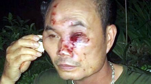 Hà Nội: Bảo vệ tòa nhà bị côn đồ đánh nhập viện - ảnh 1