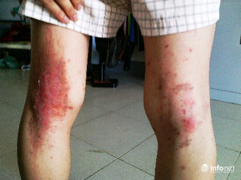 Hàng ngàn sinh viên bị kiến ba khoang tấn công đến khốn khổ - ảnh 1