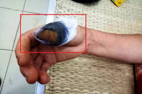 Hi hữu: Bị cắn đứt ngón tay vì nắm rau mùng tơi - ảnh 1
