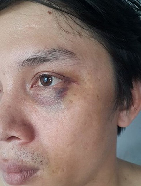 Vụ phóng viên Hà Nội Mới bị đánh tím mắt: Băng ghi âm sẽ phơi bày sự thật? - ảnh 1