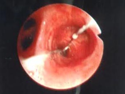 Kẹp niềng răng 8 năm nằm trong phế quản - ảnh 1