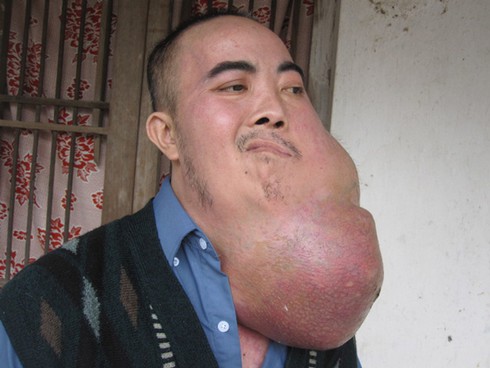 Xót xa người đàn ông mang khối u 10kg trên mặt - ảnh 1