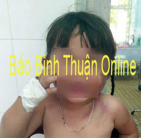 Hàm Tân: Bắt giam cha dượng gây thương tích cho cháu bé 3 tuổi - ảnh 1