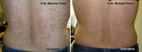 Điều trị bệnh vẩy nến thể giọt bằng thảo dược hiệu quả và an toàn - ảnh 1