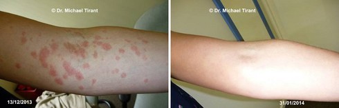 Điều trị bệnh vẩy nến thể giọt bằng thảo dược hiệu quả và an toàn - ảnh 2