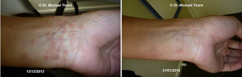 Điều trị bệnh vẩy nến thể giọt bằng thảo dược hiệu quả và an toàn - ảnh 3