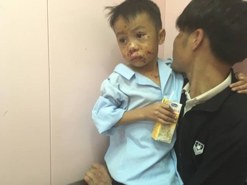 Hà Tĩnh: Đốt kíp nổ, 2 anh em nhập viện cấp cứu - ảnh 1