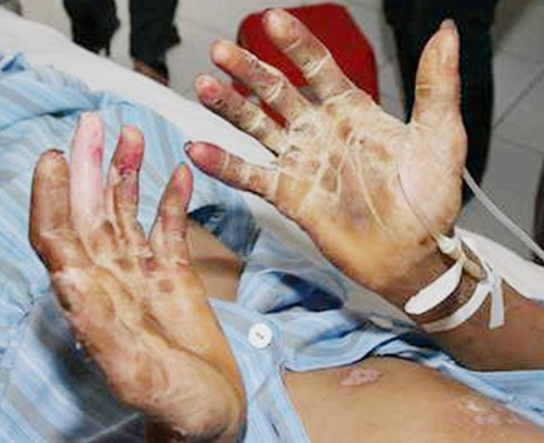 Bệnh liên cầu khuẩn lợn kinh khủng ra sao? - ảnh 2