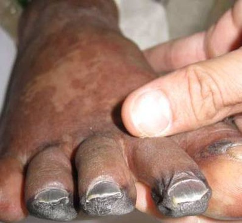 Bệnh liên cầu khuẩn lợn kinh khủng ra sao? - ảnh 3