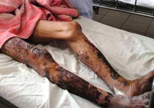 Bệnh liên cầu khuẩn lợn kinh khủng ra sao? - ảnh 1